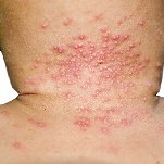 best pimple treatment in bangalore